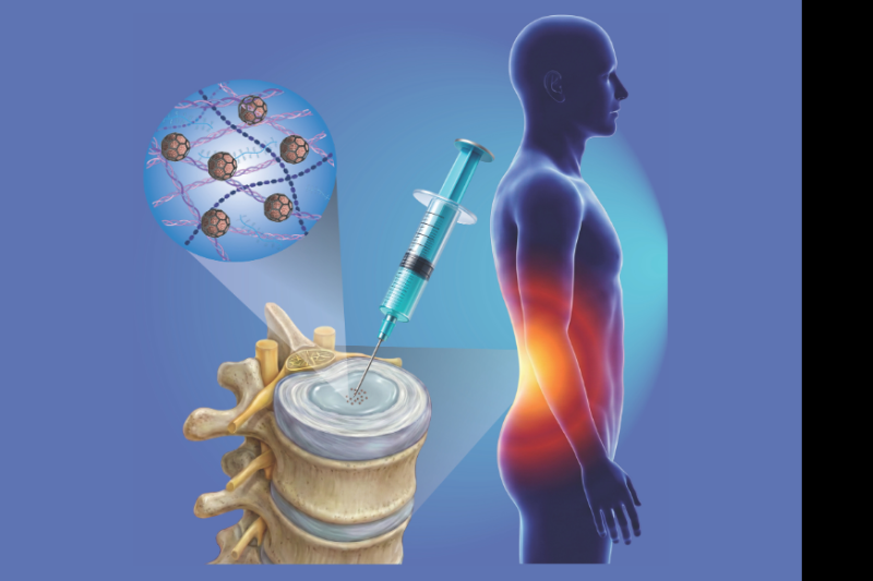 Bioprinting Breakthrough Offers New Hope for Low Back Pain Relief